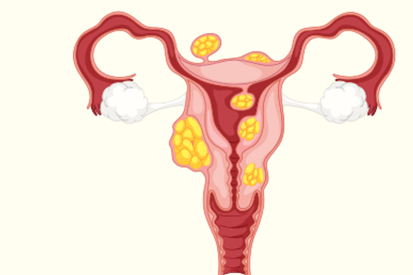 Ginecólogos especialistas en miomas