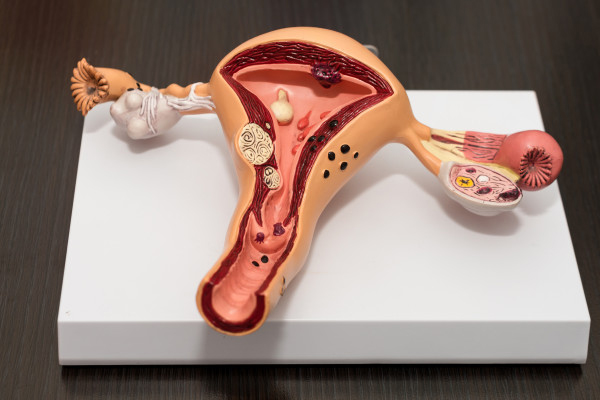Ginecólogos especialistas en VPH